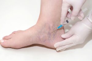 The future of spider vein treatment